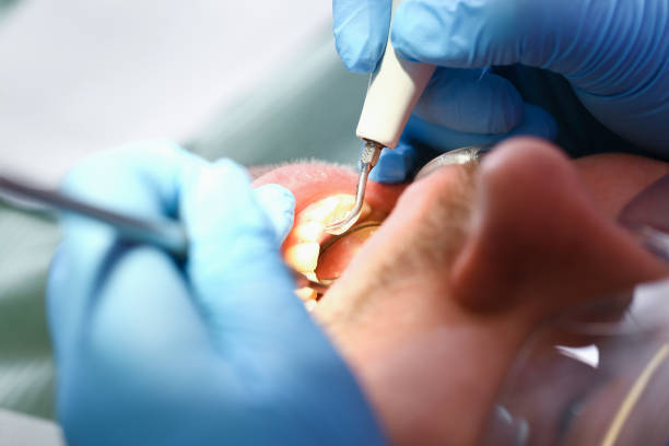 Best Emergency Tooth Extraction in Crockett, CA